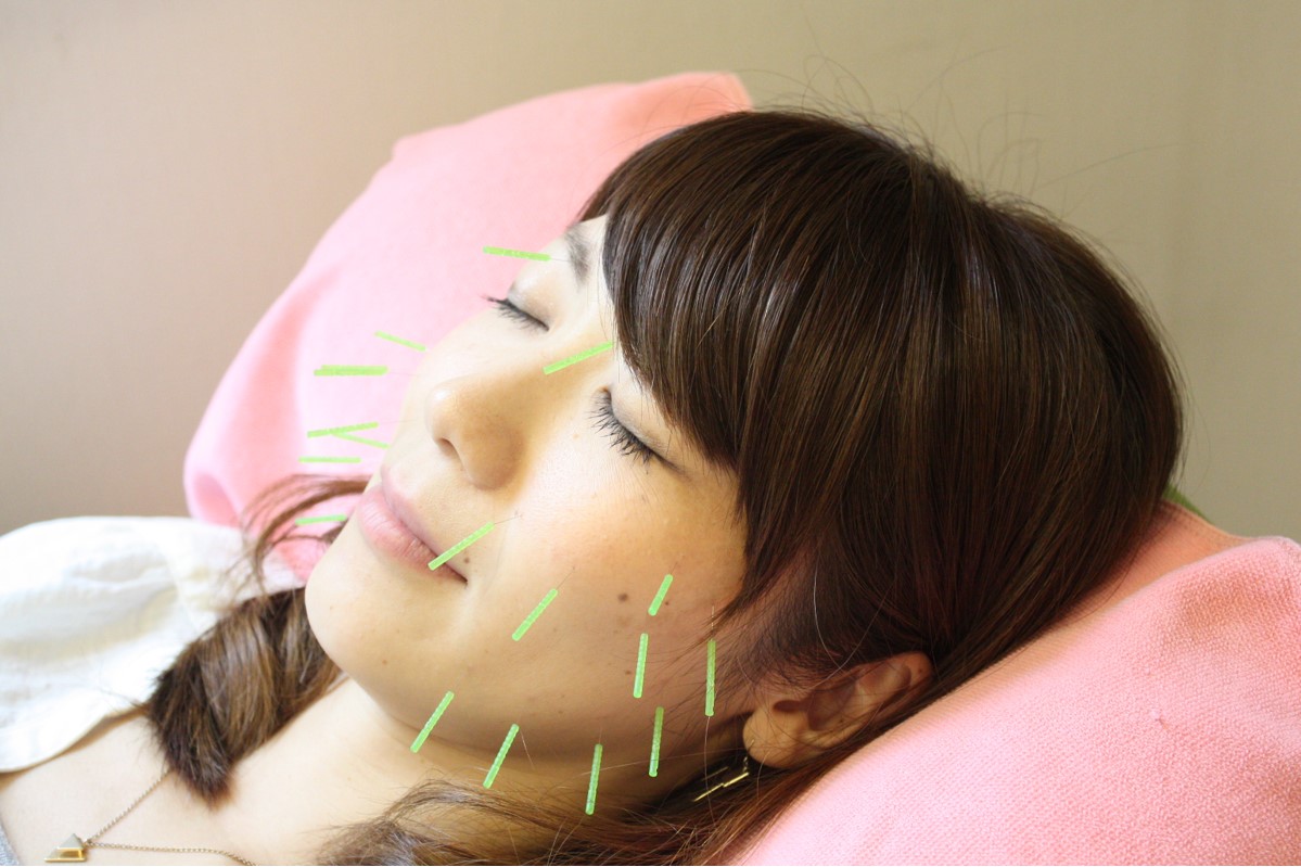 明石で美容鍼と小顔矯正を受けられるすぎおか鍼灸接骨院